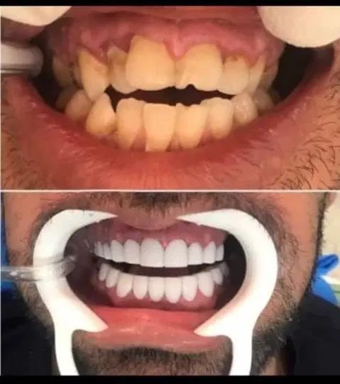 دندانپزشکی/لمینت/روکش|خدمات آرایشگری و زیبایی|تهران, فلسطین (میدان انقلاب)|دیوار