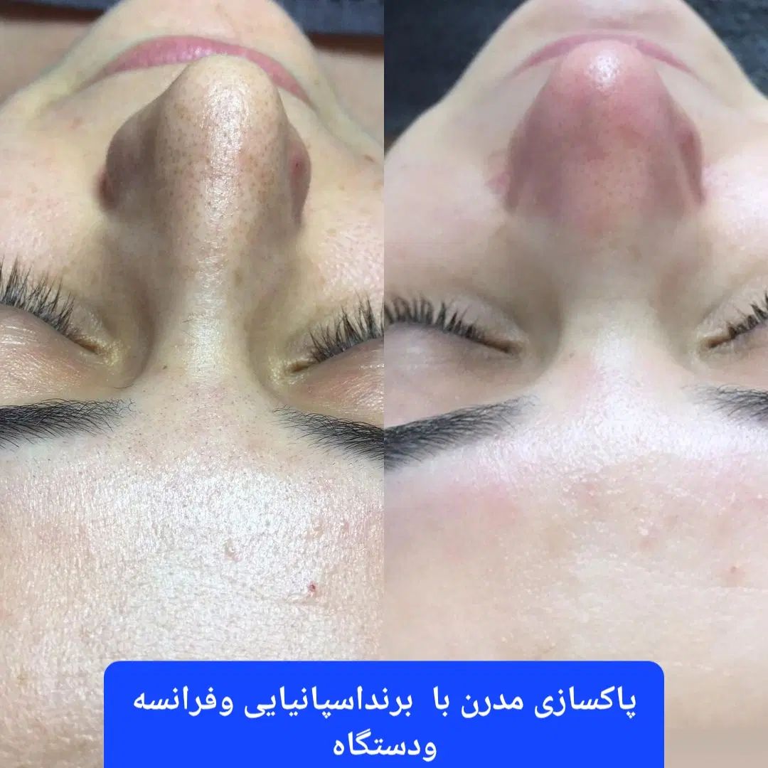 فیشال تخصصی درمانی در کلینیک زیبایی صبا|خدمات آرایشگری و زیبایی|تهران, عباس‌آباد|دیوار