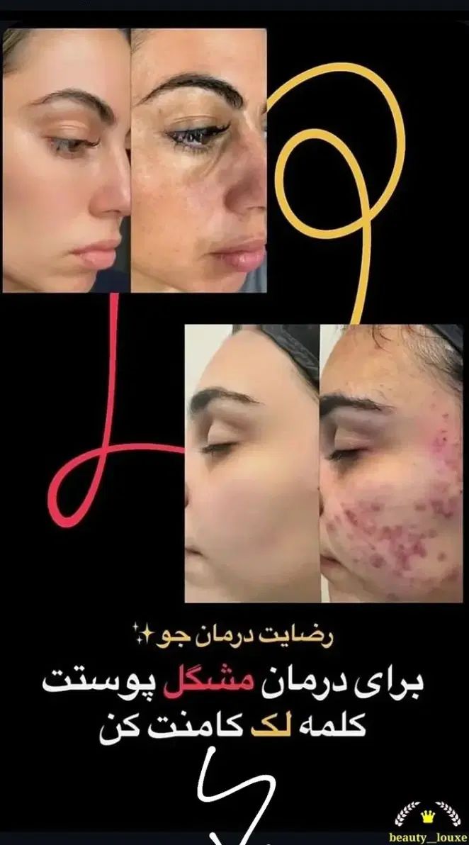 سرم مغذی و ویتامین آ، کرم ضد لک لاکچری کوین|آرایشی، بهداشتی، درمانی|نیشابور, شهرک بسیج|دیوار