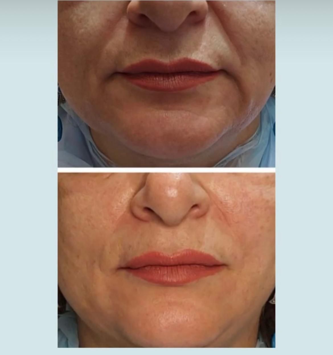 ژل فیلر بوتاکس جوانسازتوسط پزشک زیبایی در کلینیک|خدمات آرایشگری و زیبایی|مشهد, کوثر|دیوار