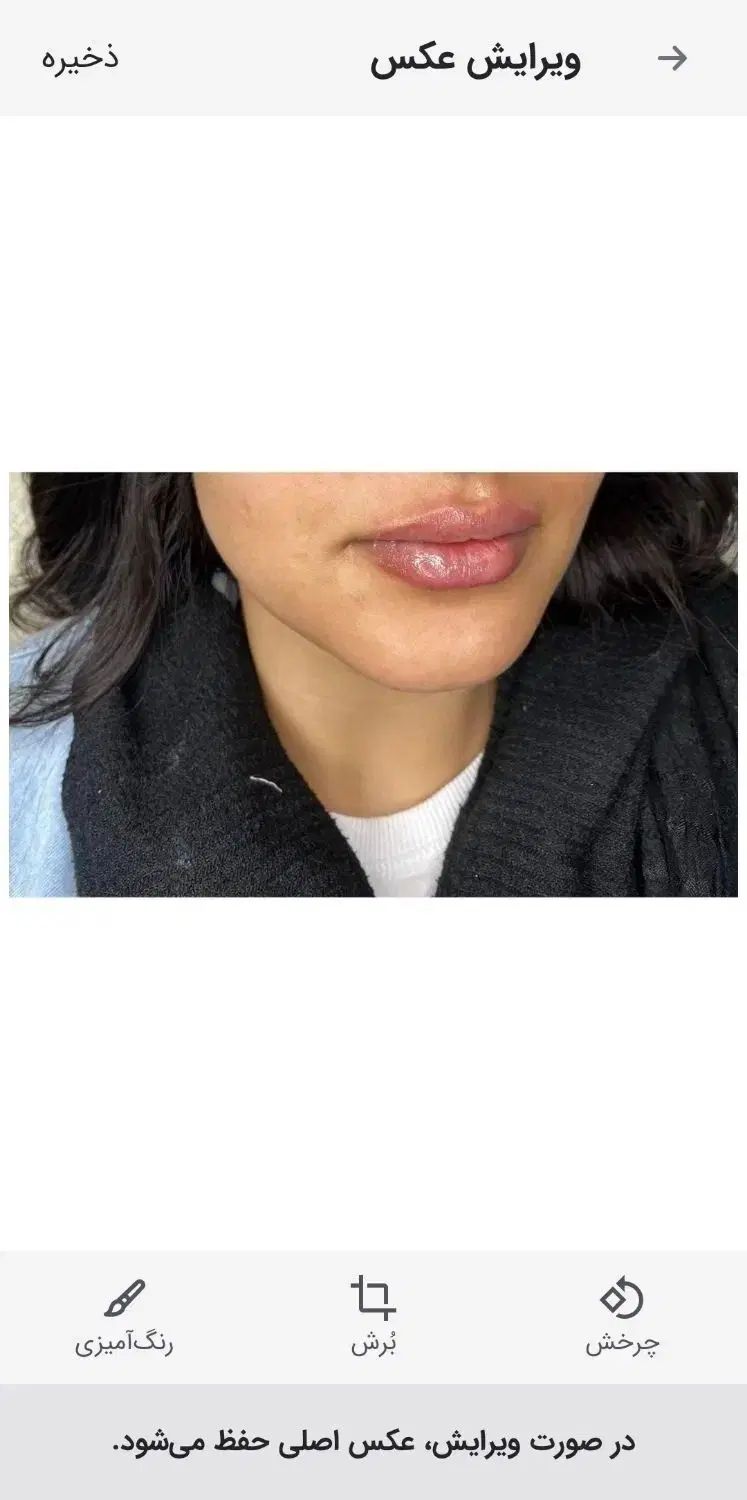 بوتاکس،فیلر،مزوژل باتخفیفی که نمی‌خوای از دست بدی|خدمات آرایشگری و زیبایی|شیراز, میرزاکوچک خان|دیوار