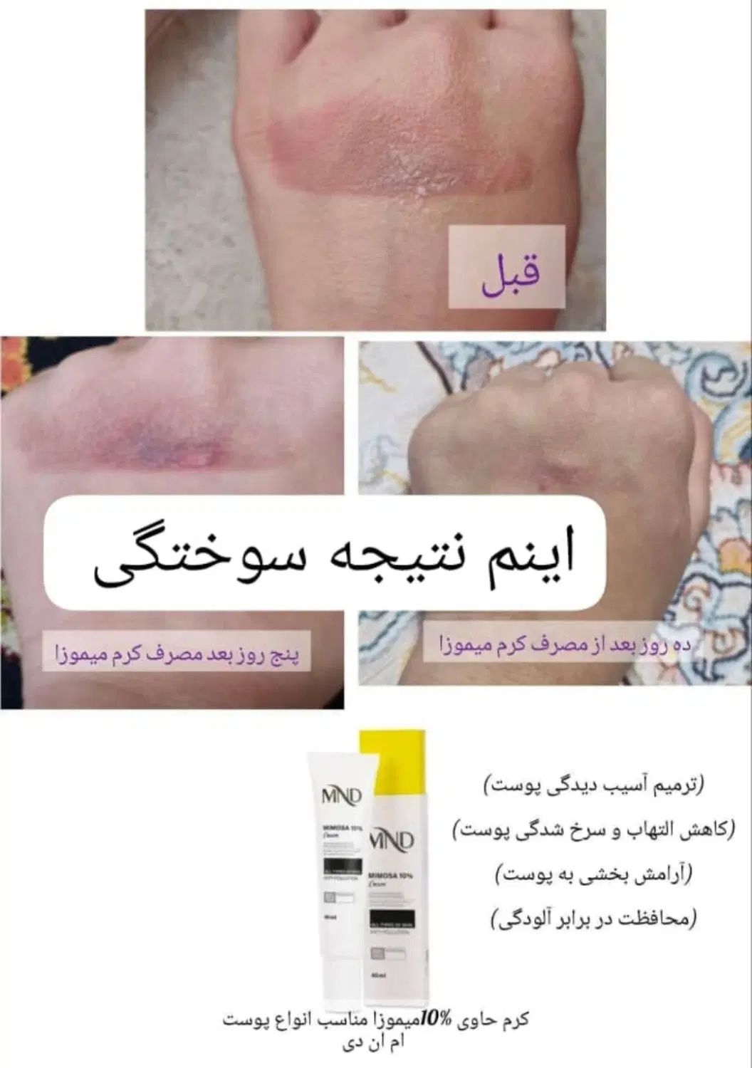 کرم حاوی %10 میموزا مناسب انواع پوست ام ان دی|آرایشی، بهداشتی، درمانی|تبریز, |دیوار