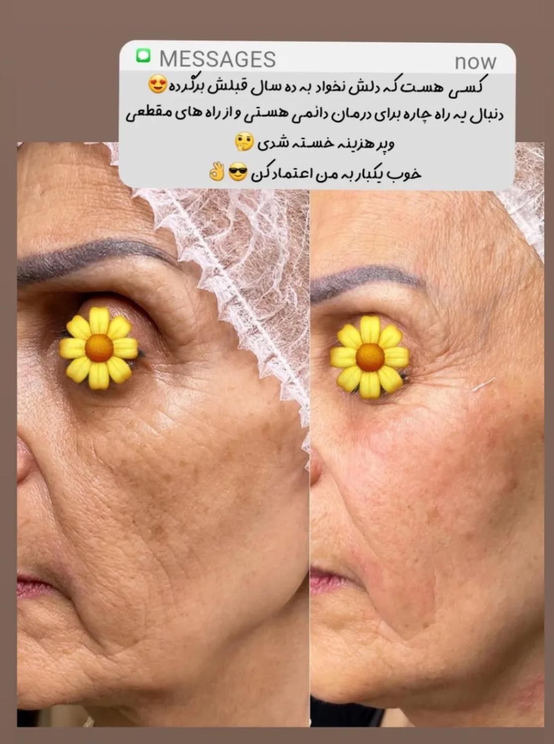 جوانسازی صورت بدون جراحی با تخفیف ویژه|خدمات آرایشگری و زیبایی|تهران, اقدسیه|دیوار
