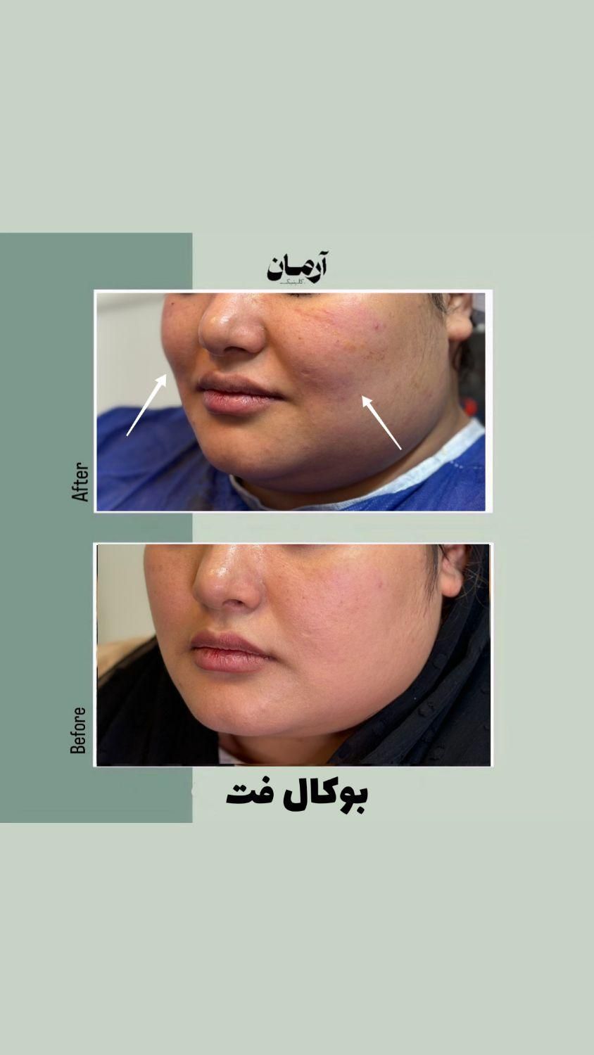 لیپو ساکشن غبغب و بوکال فت ( + شرایط )|خدمات آرایشگری و زیبایی|مشهد, گلبرگ شمالی|دیوار