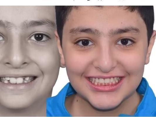 کامپوزیت فیسینگ ارتودنسی بزرگسالان و کودکان بیهوشی|خدمات آرایشگری و زیبایی|شیراز, زرگری|دیوار