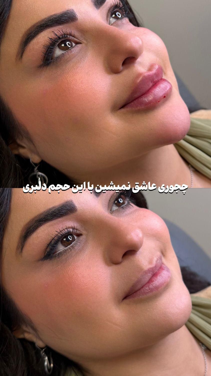 آموزش تزریقات ژل و بوتاکس|خدمات آموزشی|تهران, تهرانپارس غربی|دیوار