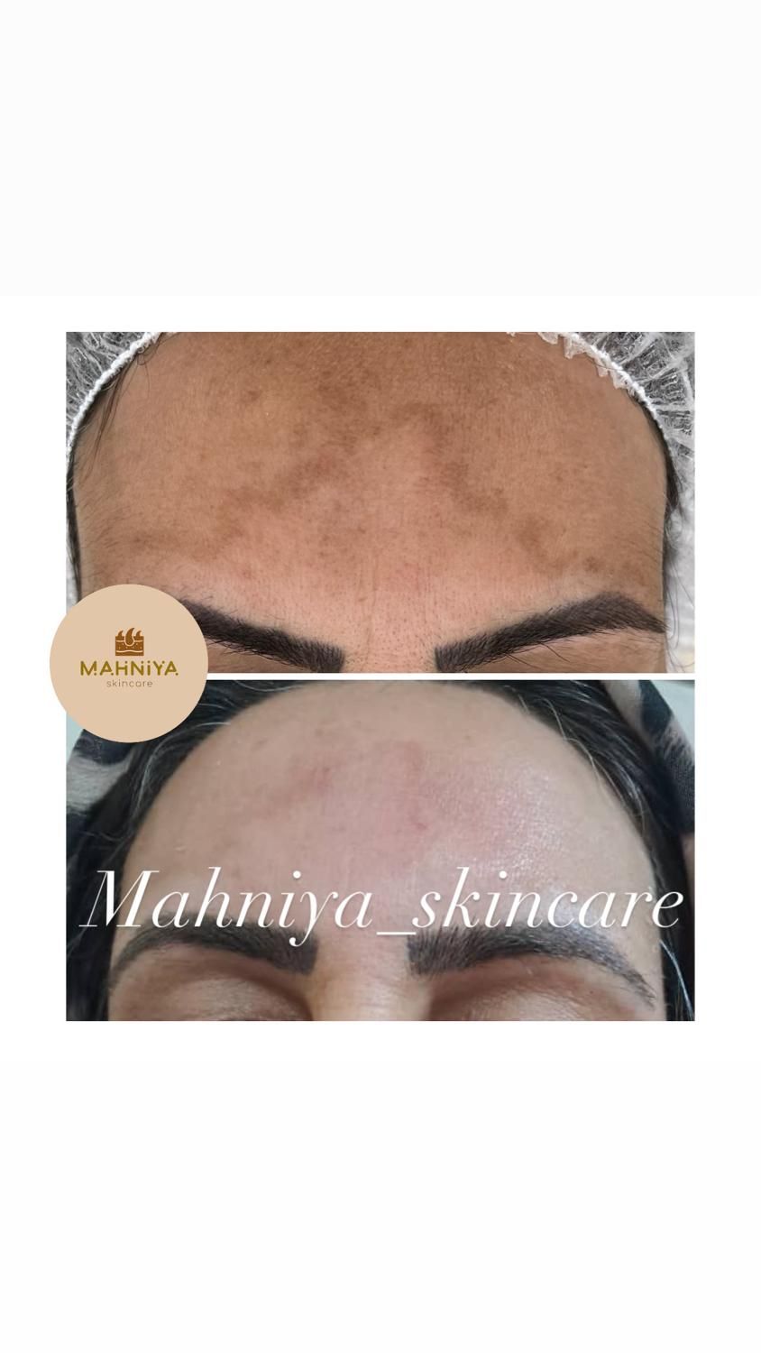 فیشال،آلگاپیل(پوست مار)هایفوتراپی،پوست کره ای|خدمات آرایشگری و زیبایی|قم, دورشهر|دیوار