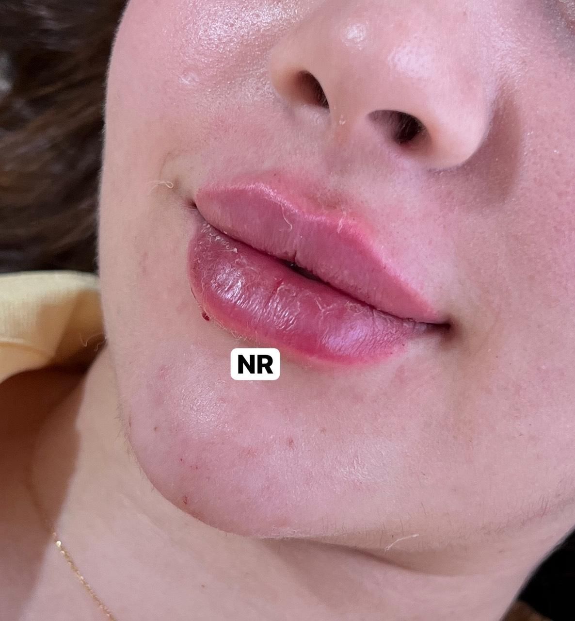ژل و فیلر و بوتاکس|خدمات آرایشگری و زیبایی|مشهد, ده دی|دیوار