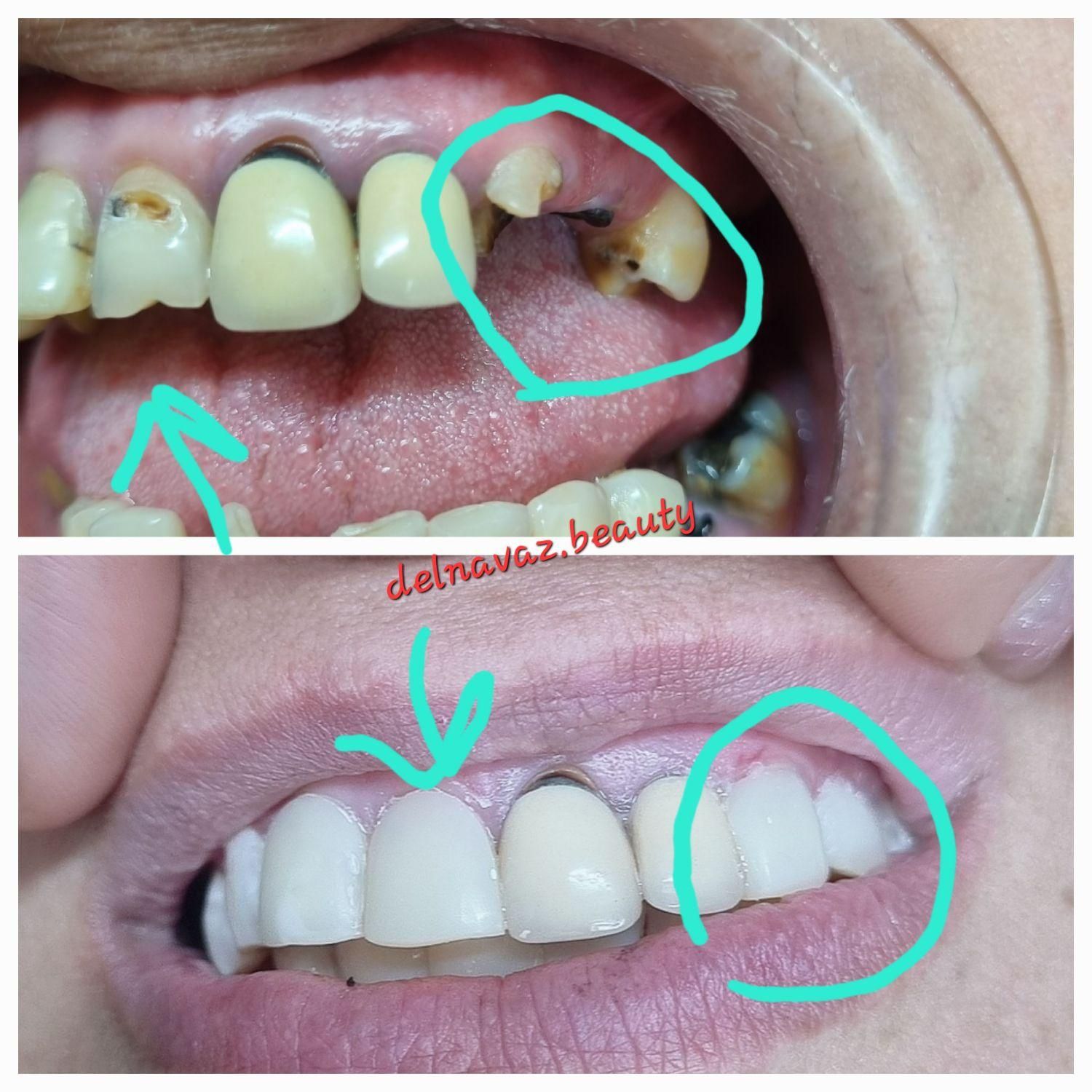 کامپوزیت دندان ژل و بوتاکس پی آرپی و لیفت نخ|خدمات آرایشگری و زیبایی|اهواز, نادری|دیوار