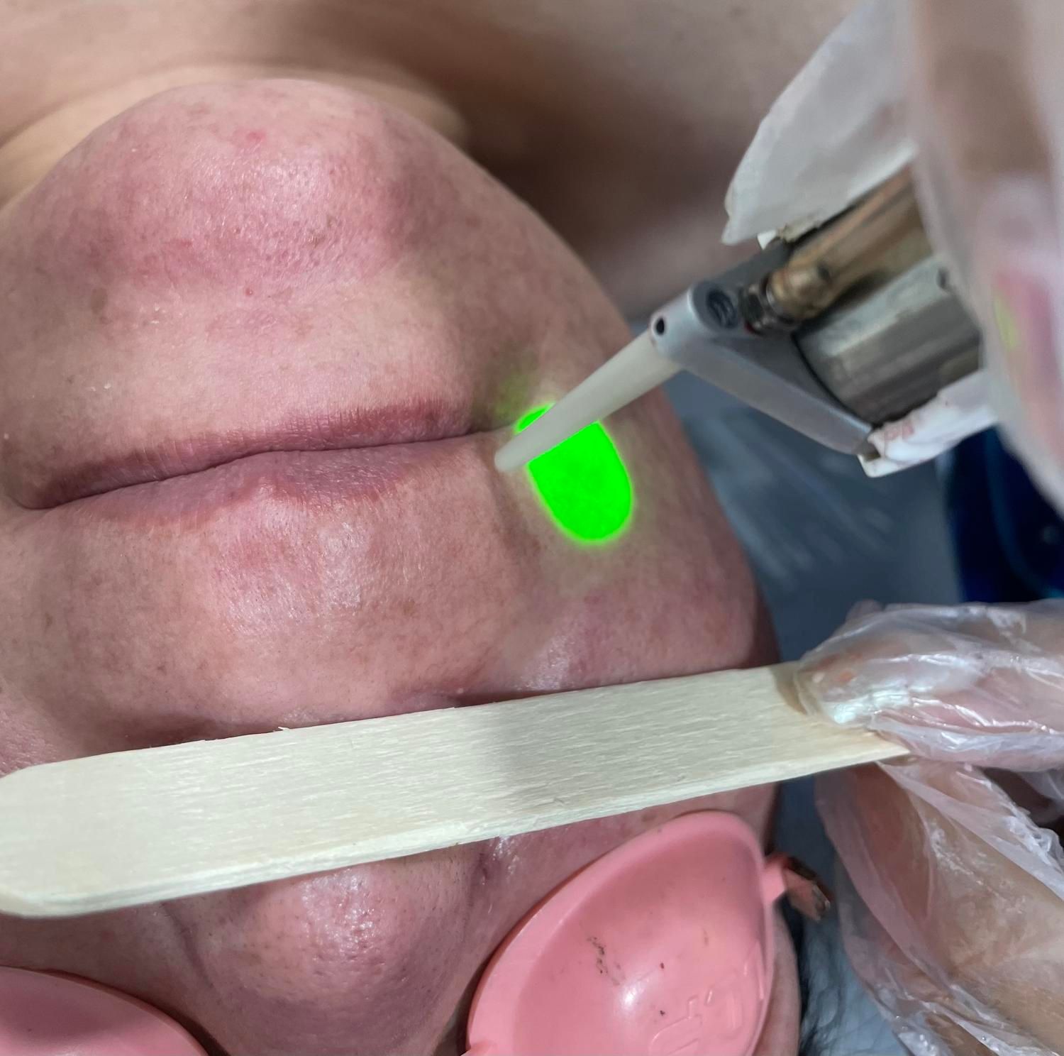 لیزر رفع موهای زائد با دستگاه دکا الکساندرایت|خدمات آرایشگری و زیبایی|کرمانشاه, |دیوار