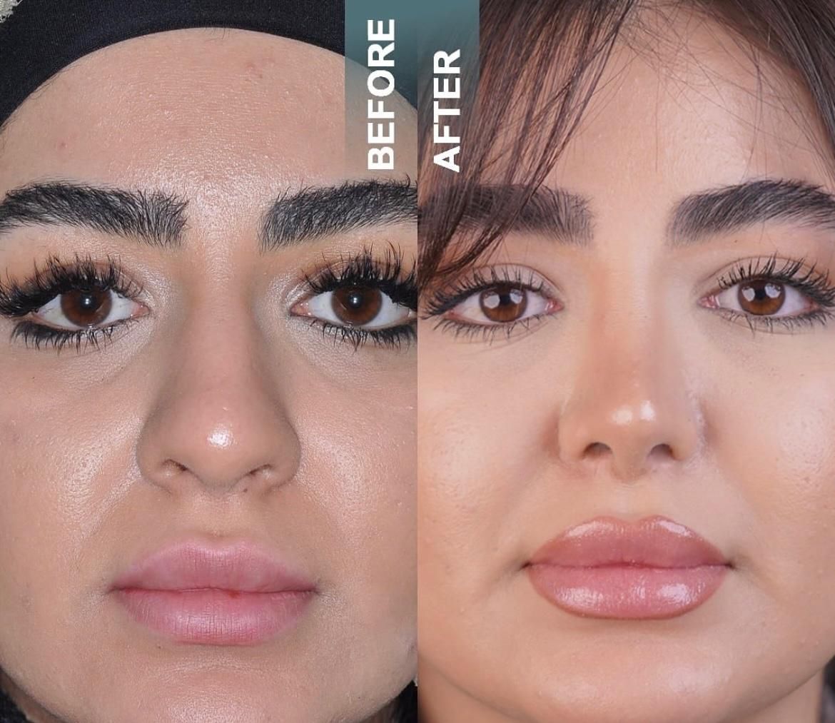 کامپوزیت لمینت ایمپلنت جراحی بینی بلفارو ساکشن|خدمات آرایشگری و زیبایی|مشهد, سجاد شهر|دیوار