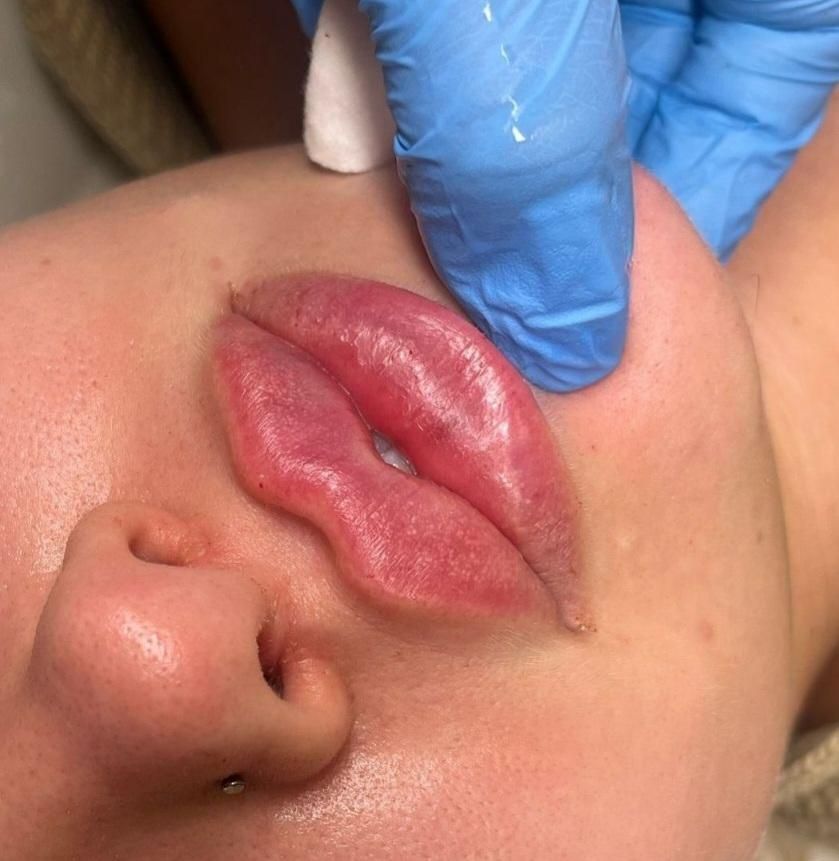 جشنواره تزریق فیلر ب مدت محدود فقط ۷۸۰تومن|خدمات آرایشگری و زیبایی|زنجان, |دیوار