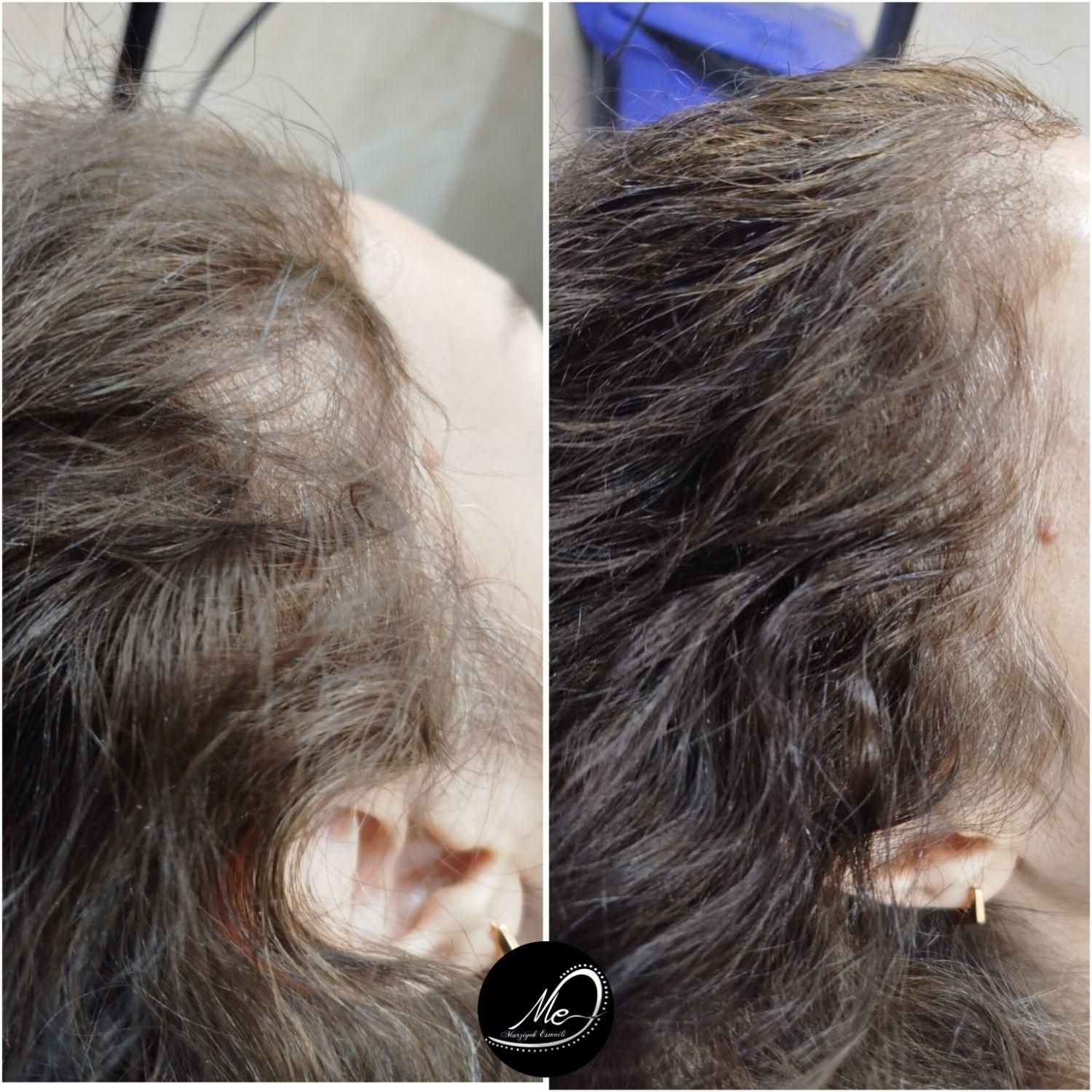 میکرواسکالپ سر|خدمات آرایشگری و زیبایی|محلات, |دیوار
