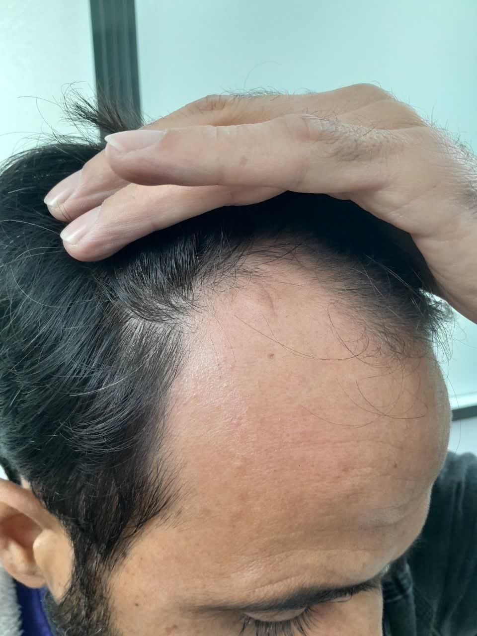 جراحی خال زگیل و میخچه و ناخن با لیزر در مطب پزشک|خدمات آرایشگری و زیبایی|قم, میرزائیه|دیوار