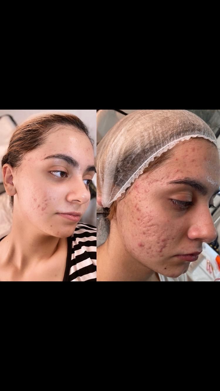 فشیال پاکسازی لیزر پوست جوانساز|خدمات آرایشگری و زیبایی|شیراز, معالی‌آباد|دیوار
