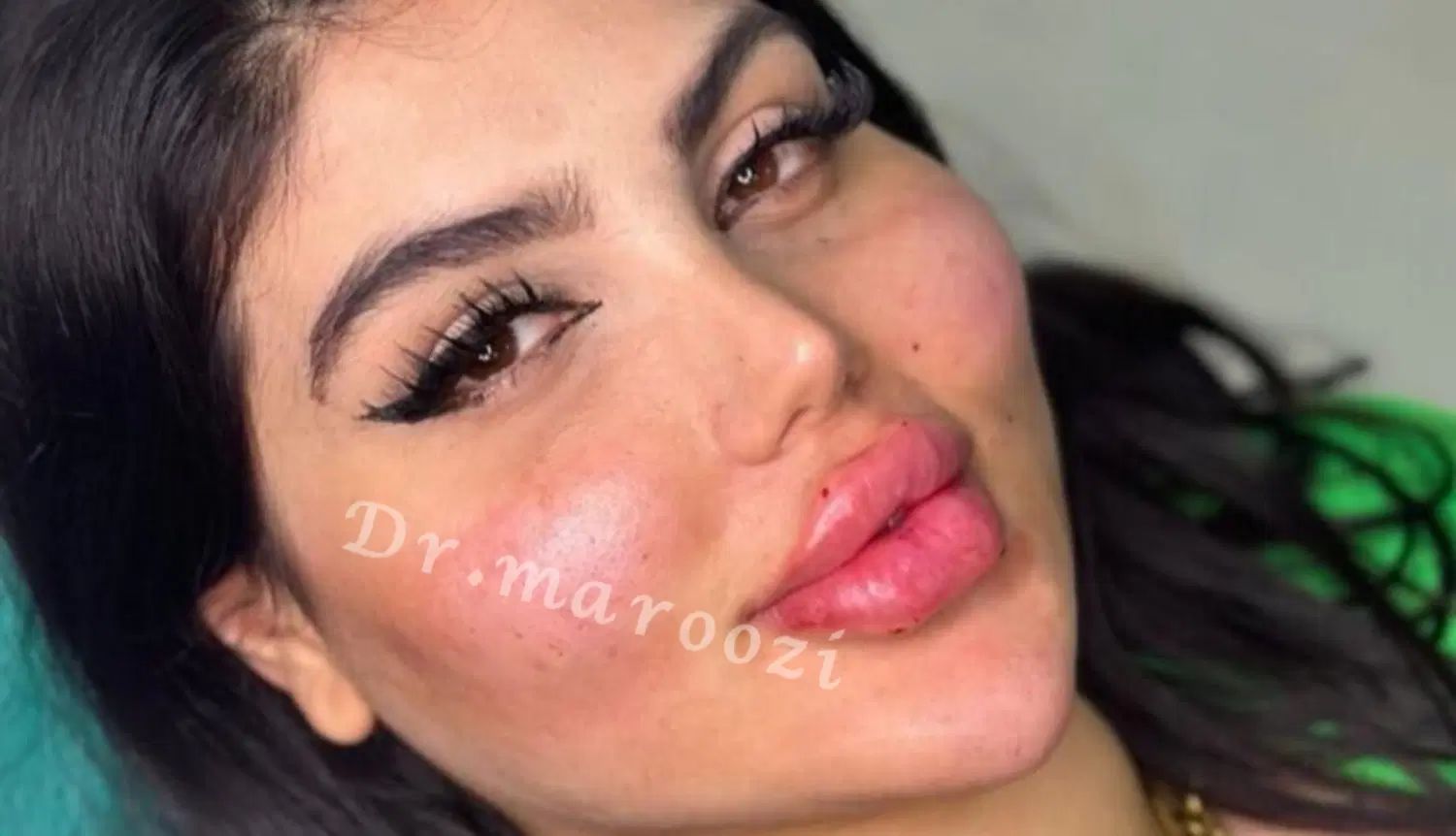 تزریق ژل لب بوتاکس لیفت ابرو کانتورینگ و آموزش|خدمات آرایشگری و زیبایی|تهران, پونک|دیوار