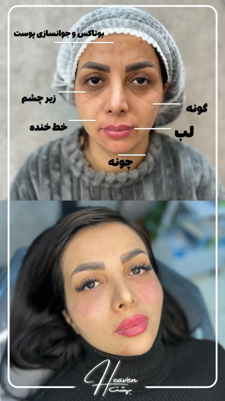 پی ار پی ژل بوتاکس فیلر نخ مزو لیزر ریمو تتو مزوژل|خدمات آرایشگری و زیبایی|مشهد, هفت تیر (حافظ)|دیوار