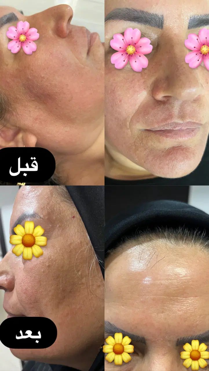 جشنواره زیبایی پوست با هایفوتراپی و آر اف فرکشنال|خدمات آرایشگری و زیبایی|قم, دورشهر|دیوار