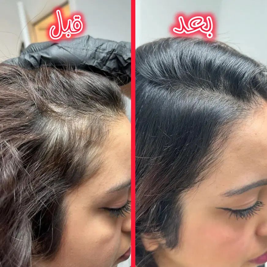 معماری صورت با فیلر/بوتاکس/پی ارپی/سلول های بنیادی|خدمات آرایشگری و زیبایی|تبریز, |دیوار