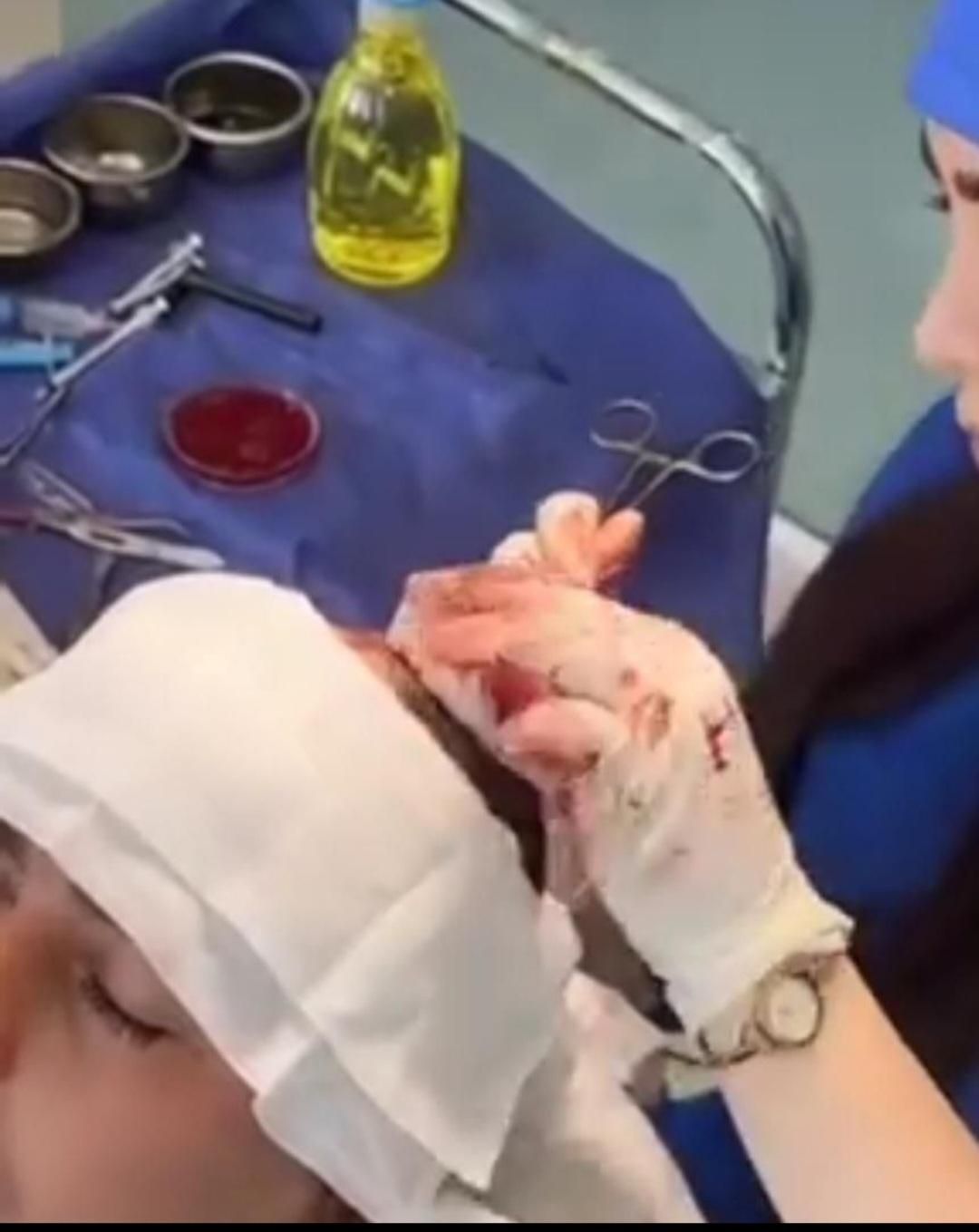 کاشت مووابرو با تخفیف درکلینیک تخصصی تبریز|خدمات آرایشگری و زیبایی|اردبیل, |دیوار