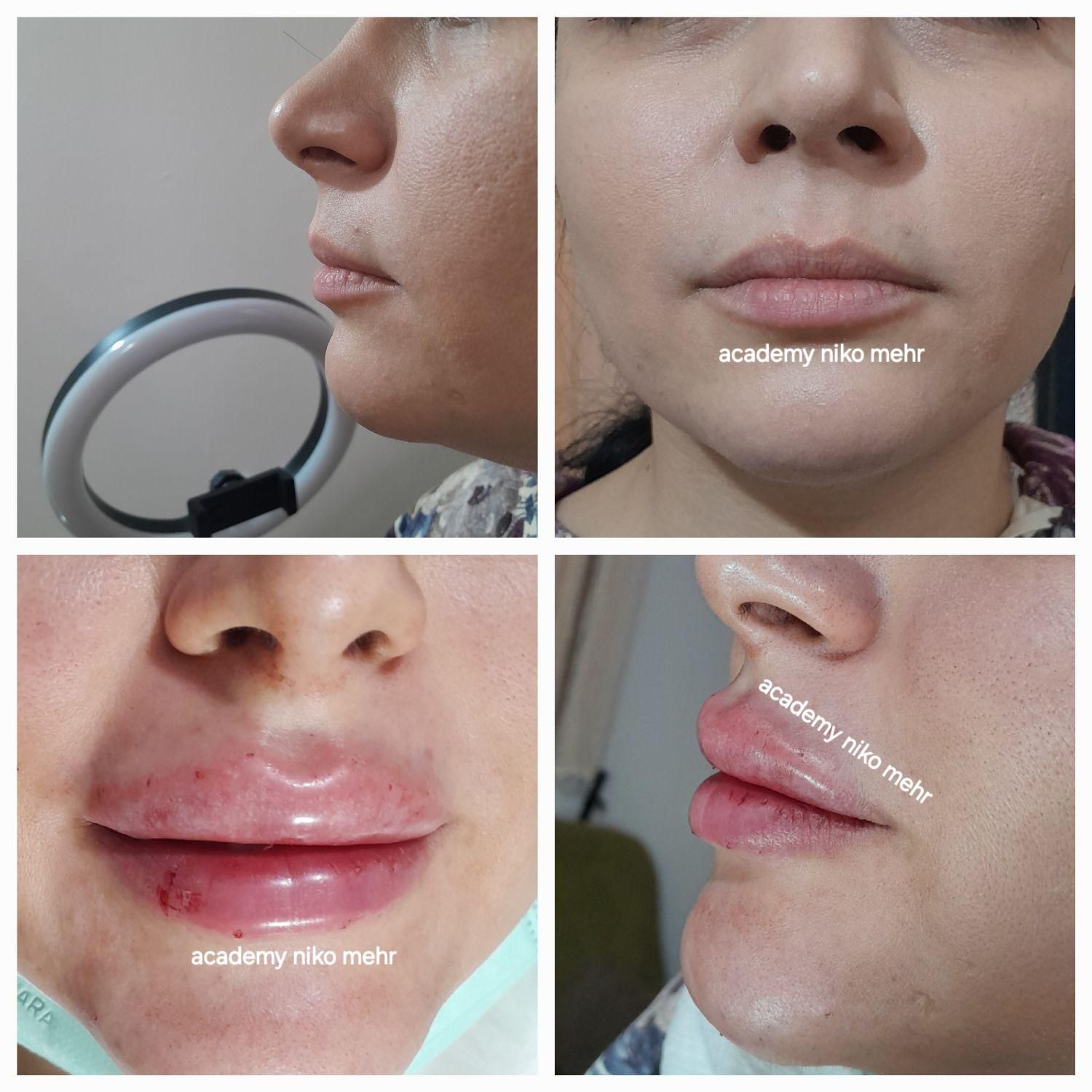 مدل بوتاکس ژل مزوتراپی میکرونیدلینگ فشیال|خدمات آرایشگری و زیبایی|فردیس, طالقانی|دیوار