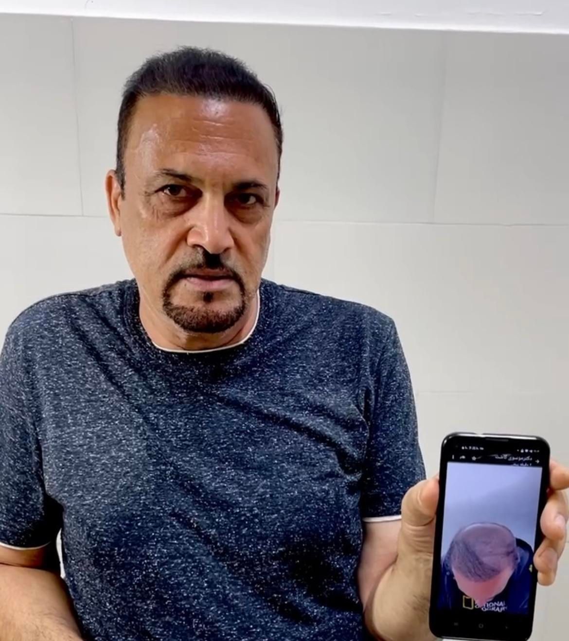 جشنواره کاشت مو ریش و ابرو|خدمات آرایشگری و زیبایی|اردبیل, |دیوار