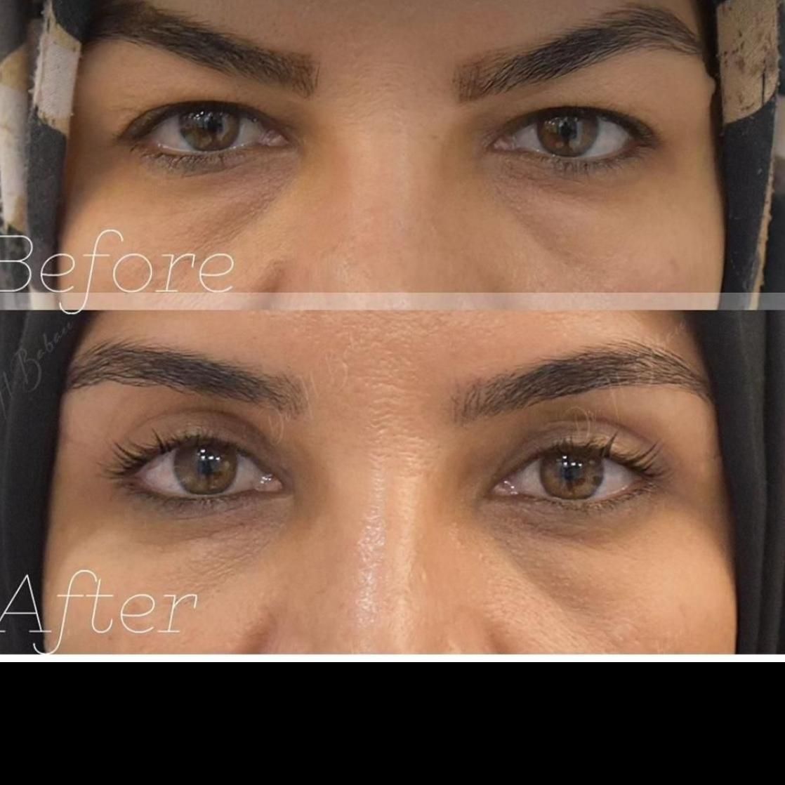 بلفاروپلاستی و ساکشن غبغب آفر ویژه|خدمات آرایشگری و زیبایی|فولادشهر, B4|دیوار