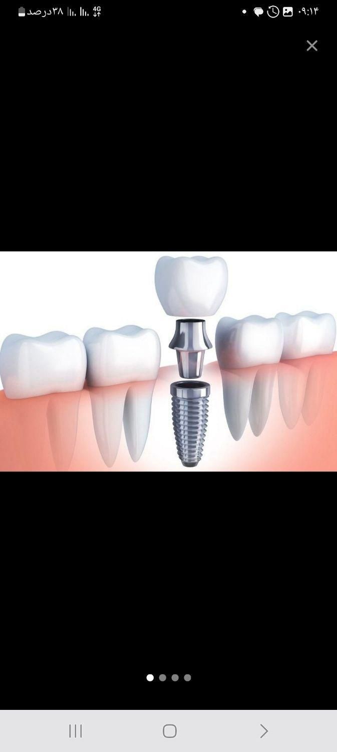 ایمپلنت (دندان ثابت) با بالاترین کیفیت وقیمت خیریه|خدمات آرایشگری و زیبایی|زاهدان, |دیوار