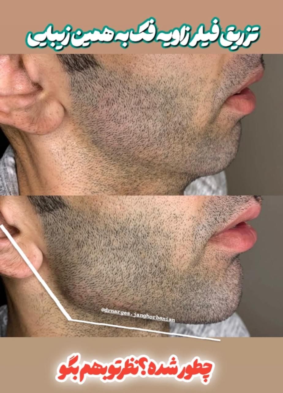 جشنواره تزریق ژل و بوتاکس|خدمات آرایشگری و زیبایی|اصفهان, دانشگاه اصفهان|دیوار
