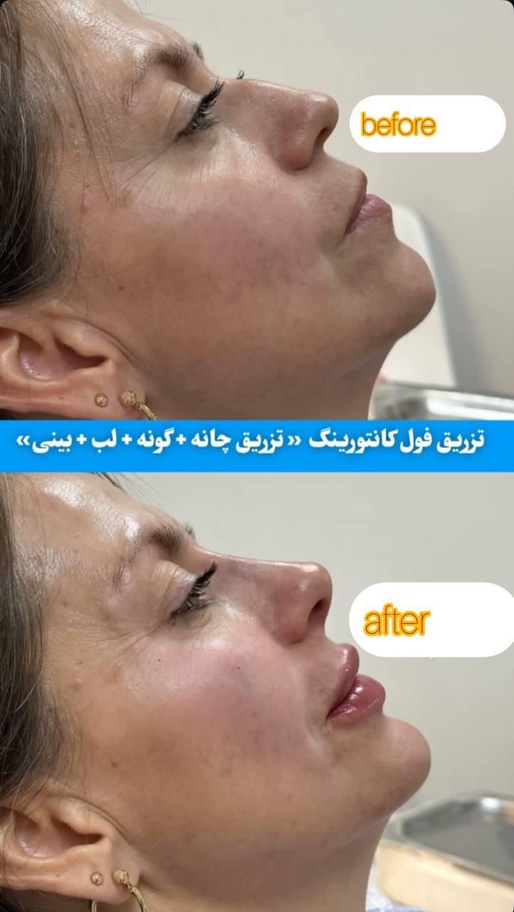ژل و بوتاکس مرو فیلر توسط دکتر تخفیف ۳۰ ٪|خدمات آرایشگری و زیبایی|مشهد, کوثر|دیوار