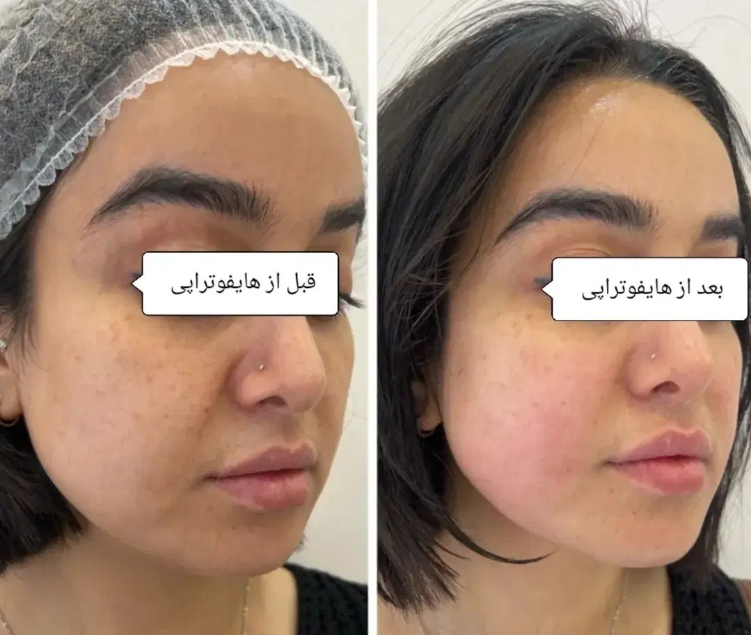 جوانسازی و لیفت پوست بدون جراحی با قویترین هایفو|خدمات آرایشگری و زیبایی|کرج, فاز ۲ مهرشهر|دیوار