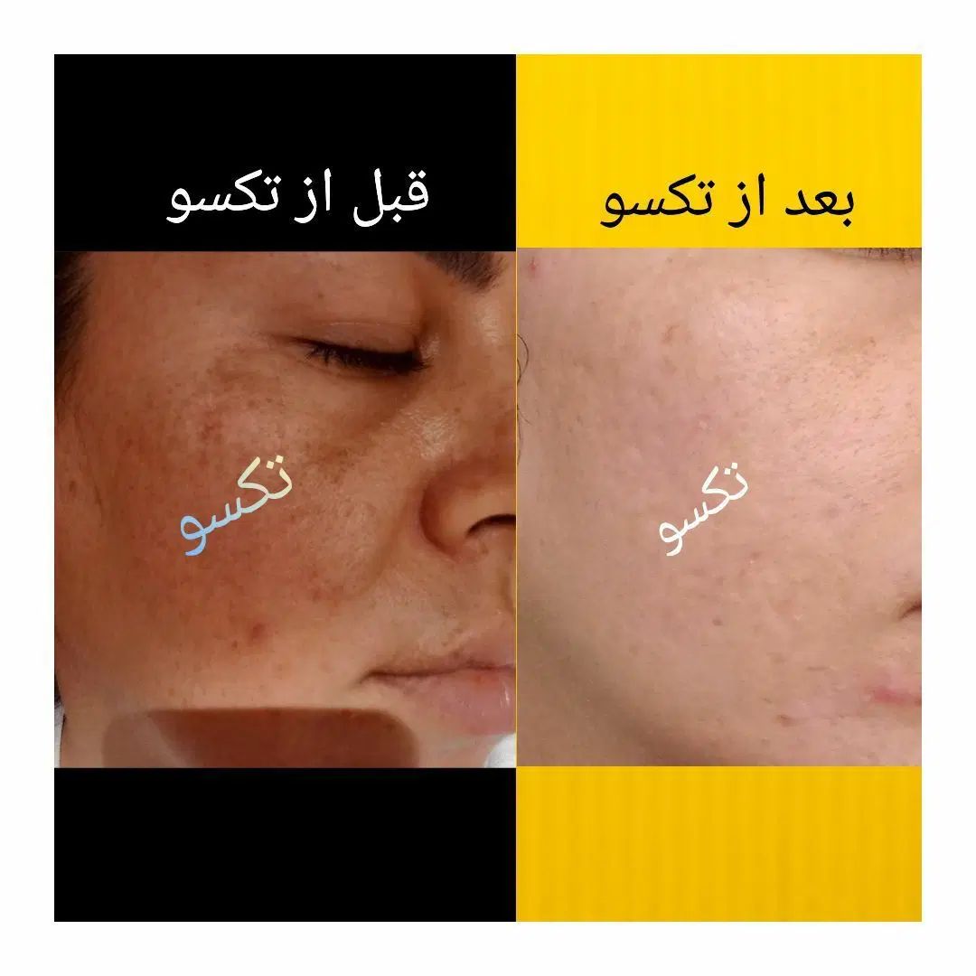 درمان تخصصی جوش های صورت|آرایشی، بهداشتی، درمانی|کرج, شهرک آسمان|دیوار