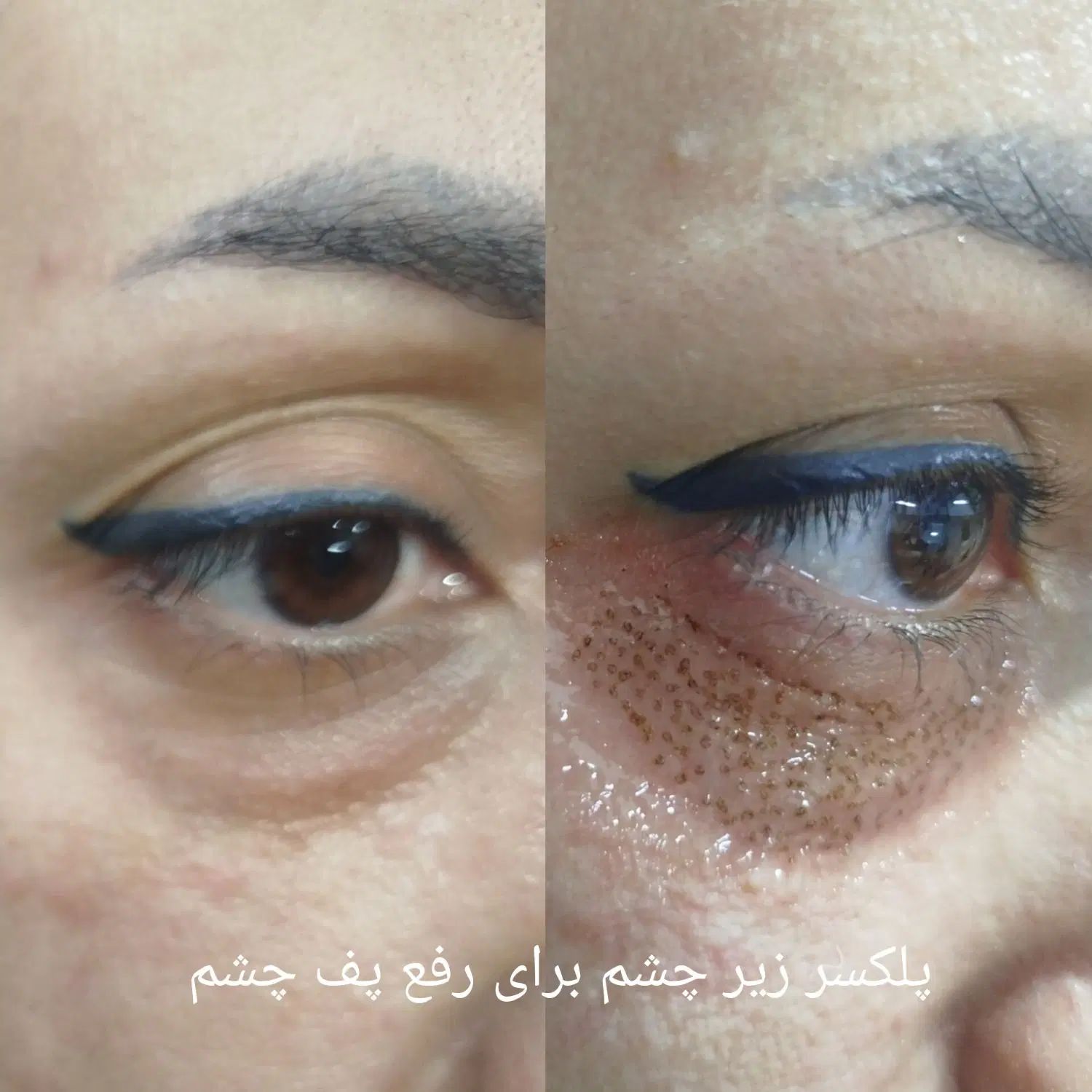 پلکسر وخال برداری ، مزونیدلینگ ، فشیال تخصصی|خدمات آرایشگری و زیبایی|مشهد, طلاب|دیوار