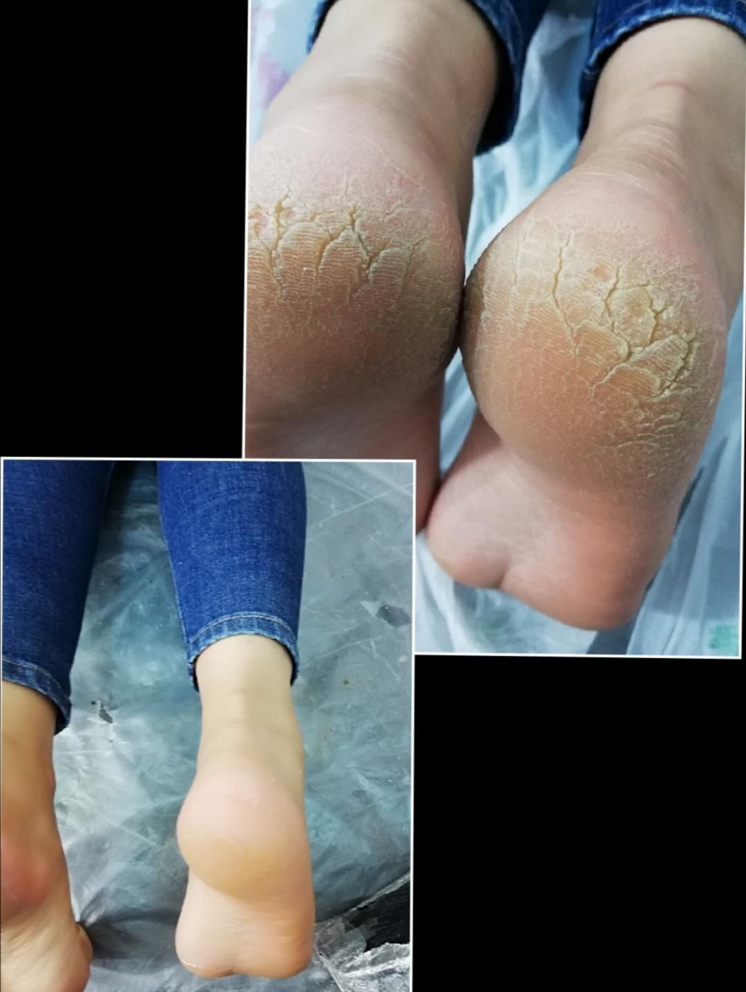 ازبین بردن تیرگی ،ازبین بردن ترک عمیق پا|خدمات آرایشگری و زیبایی|بوشهر, |دیوار