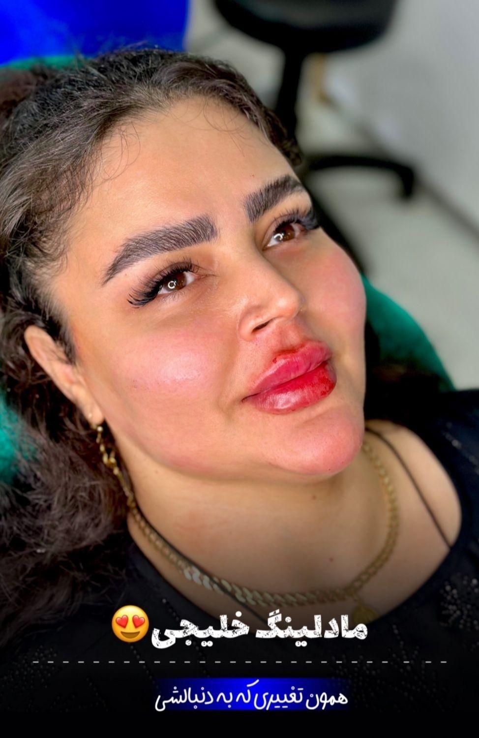 تزریق ژل،بوتاکس،فیلر،مزوتراپی،پی آر پی هایفو|خدمات آرایشگری و زیبایی|اردبیل, |دیوار