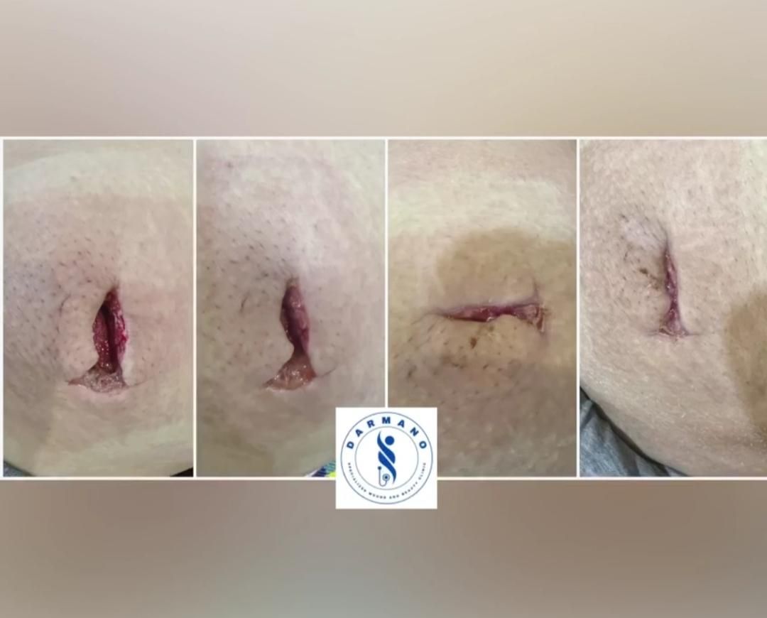 کلینیک تخصصی درمان انواع زخم(بستر و دیابت) فردوس|خدمات آرایشگری و زیبایی|اصفهان, محله سفلی|دیوار