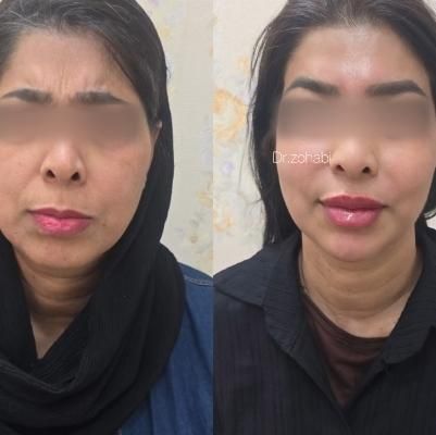 پنجاه درصد تخفیف بوتاکس|خدمات آرایشگری و زیبایی|اهواز, پادادشهر|دیوار