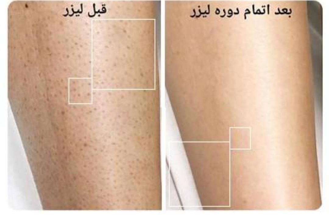 لیزر موهای زائد با جوابدهی تضمینی|خدمات آرایشگری و زیبایی|فولادشهر, B5|دیوار