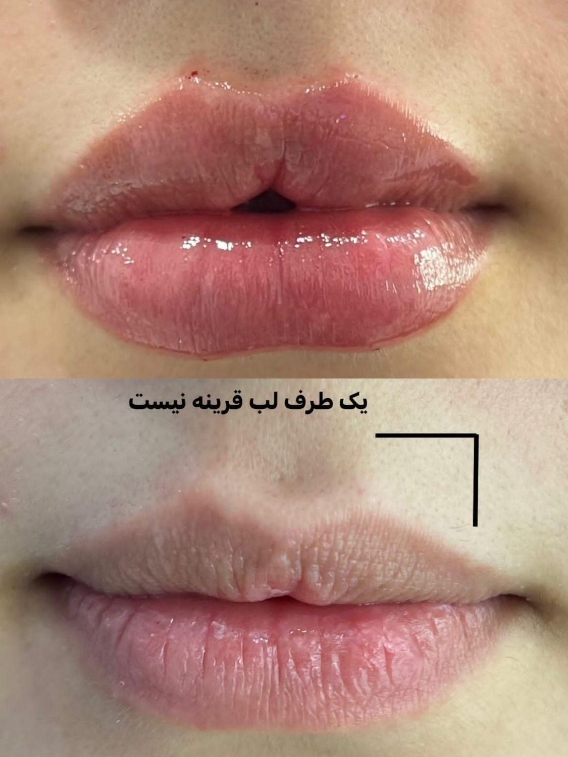 لیزر هایفو ژل بوتاکس ریمو تتو|خدمات آرایشگری و زیبایی|بوشهر, |دیوار