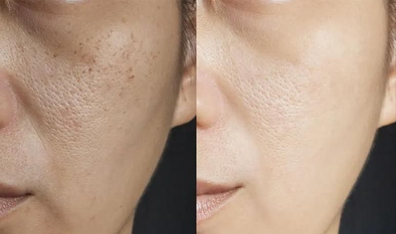 فیشیال تخصصی ، جوانسازی ، پاکسازی ، فیشال صورت|خدمات آرایشگری و زیبایی|یزد, |دیوار