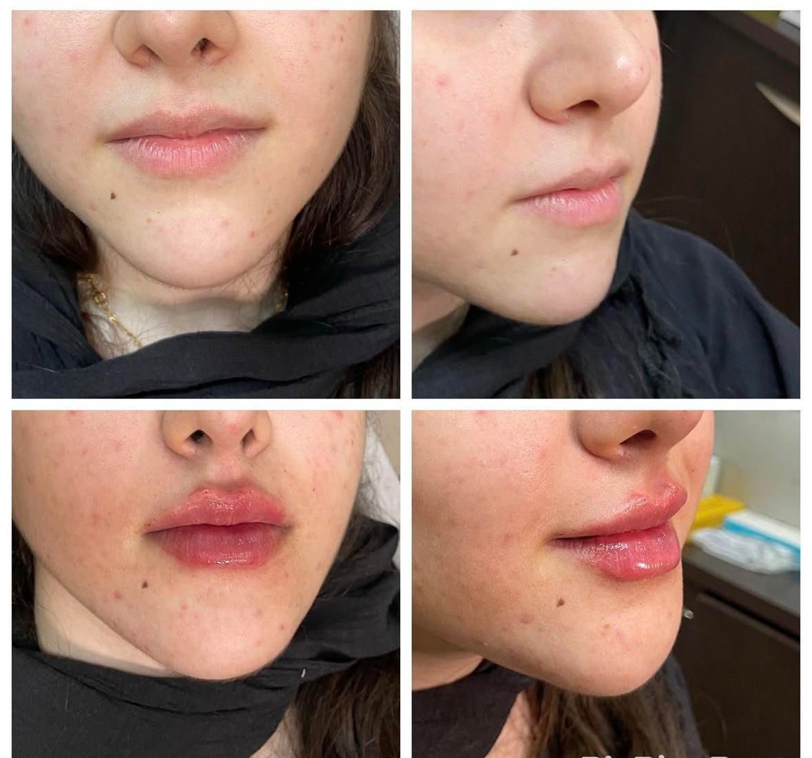 آموزش تزریق فیلر،بوتاکس و مزوولیفت با نخ توسط پزشک|خدمات آموزشی|تهران, نظامی گنجوی (توانیر)|دیوار