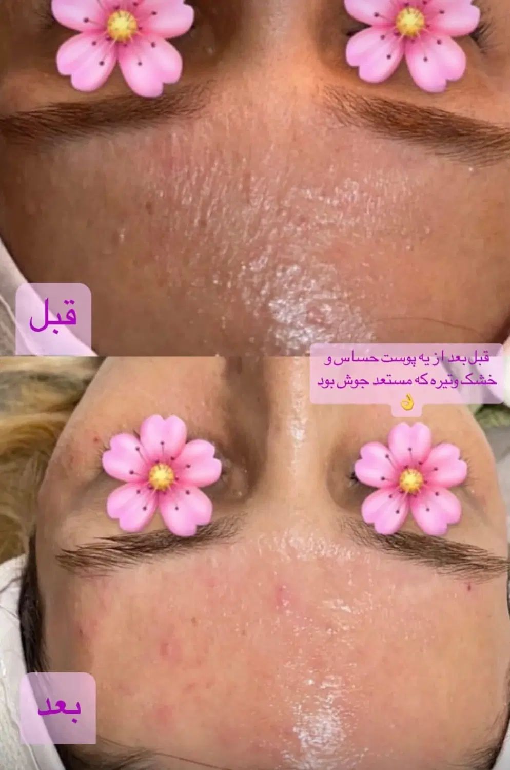پاکسازی پوست با تخفیف ویژه|خدمات آرایشگری و زیبایی|رشت, استقامت ۱|دیوار