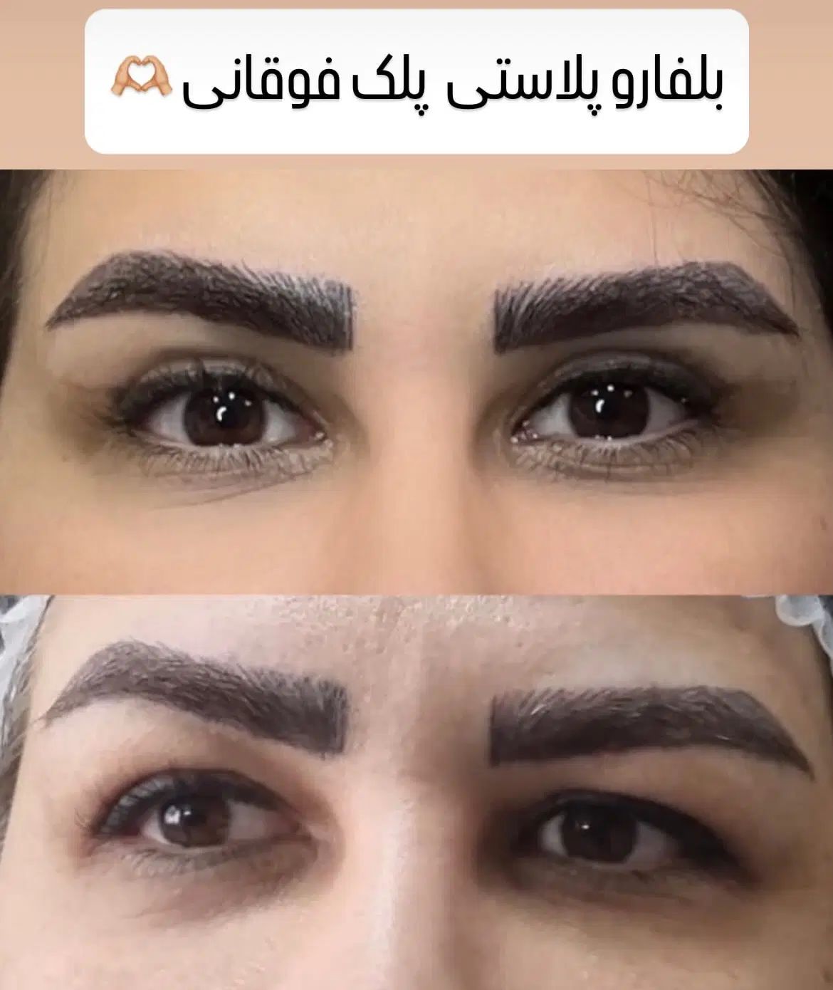 خدمات زیبایی توسط متخصص بلفارو بوتاکس لیفت زاویه|خدمات آرایشگری و زیبایی|اصفهان, گلزار|دیوار