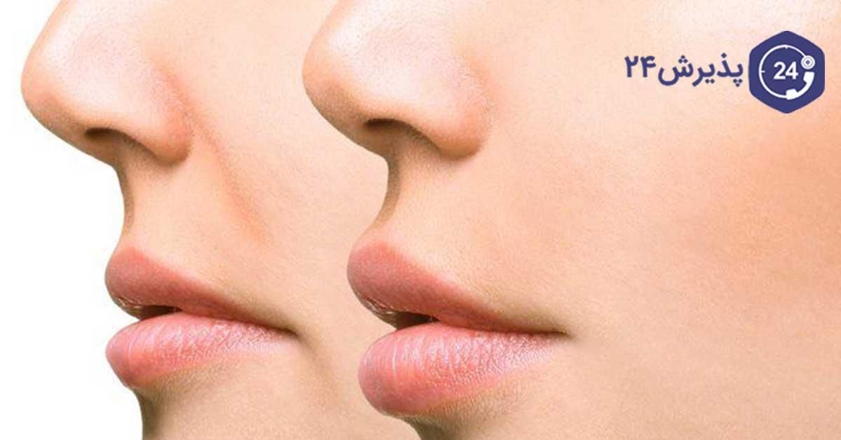چاقی صورت صد در صد  تضمینی|آرایشی، بهداشتی، درمانی|تهران, شهرآرا|دیوار