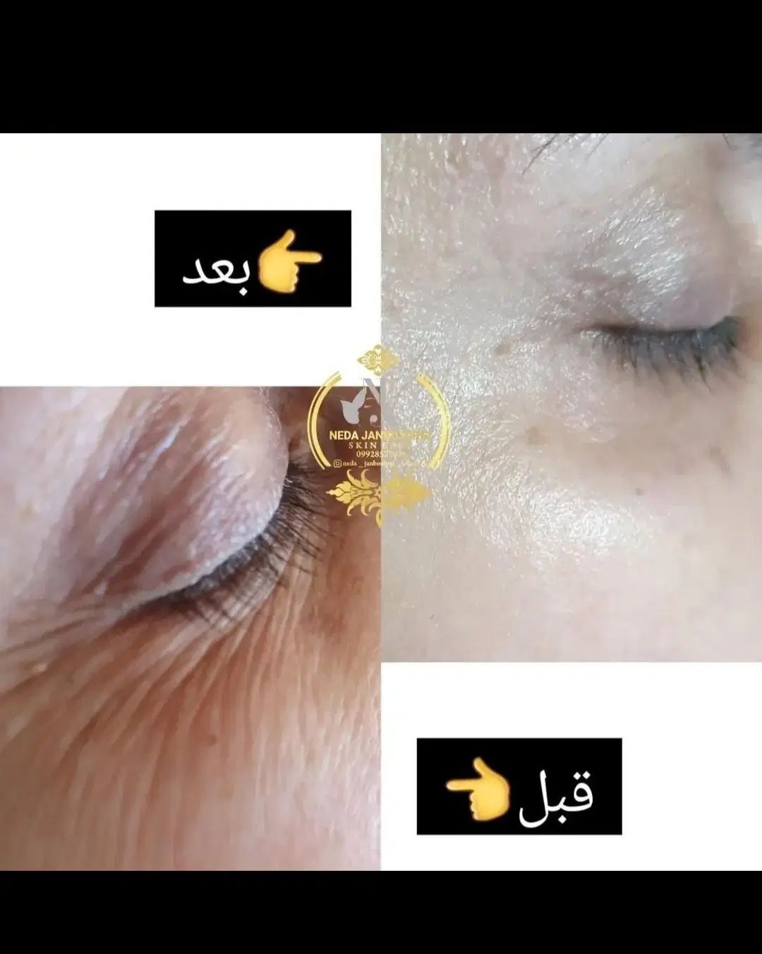 فیشال و پاکسازی پوست زیر نظر متخصص پوست|خدمات آرایشگری و زیبایی|رشت, بوسار|دیوار