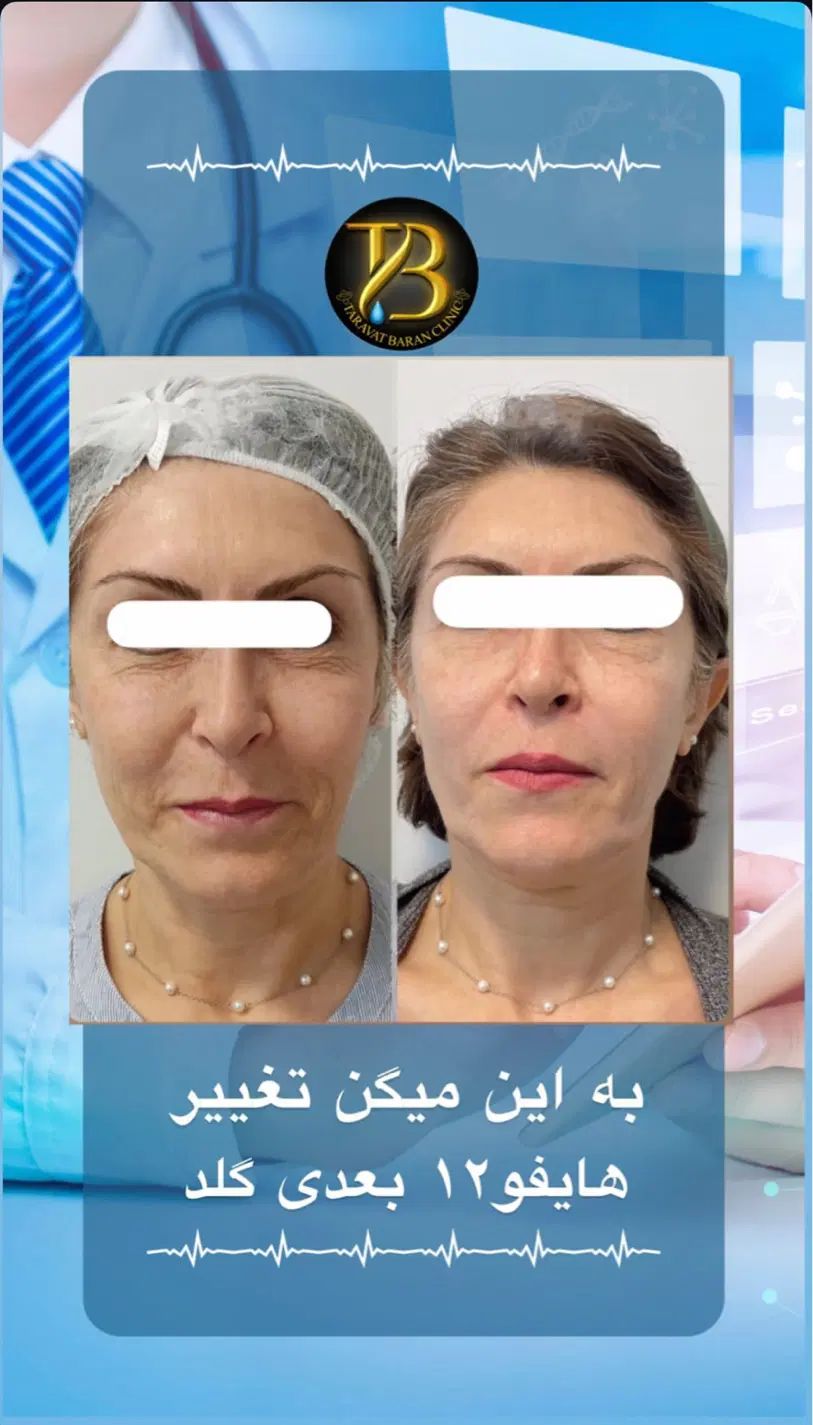 روشن‌کننده هایفو لیزرموزائد پی‌آر‌پی حجم‌سینه‌باسن|خدمات آرایشگری و زیبایی|تهران, صادقیه|دیوار