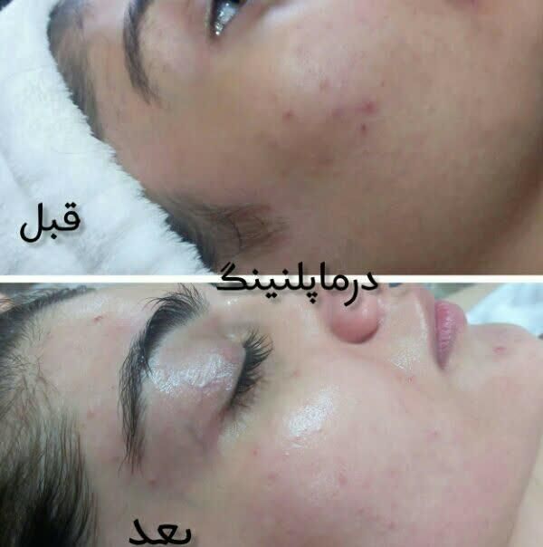 کربن تراپی صورت و بدن|خدمات آرایشگری و زیبایی|فردیس, فردیس|دیوار