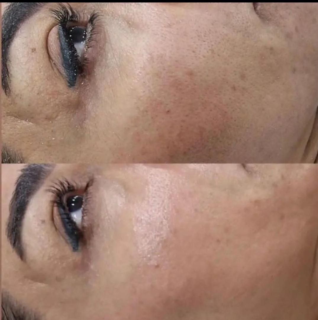 آموزش فیشال و پاکسازی تخصصی پوست مزونیدلینگ مزوایت|خدمات آرایشگری و زیبایی|مشهد, احمدآباد|دیوار