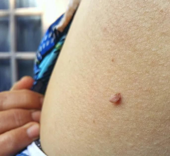 درمان زگیل پوستی/کرایو تراپی و لیزر/hpv|خدمات آرایشگری و زیبایی|اهواز, کیانپارس |دیوار