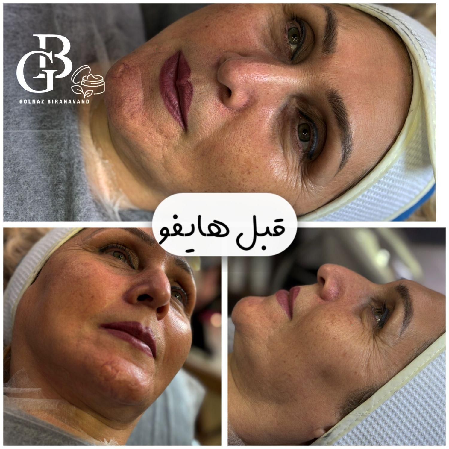 فیشیال.کربن.لیزر.لاغری.هایفو|خدمات آرایشگری و زیبایی|کرج, کوی زنبق|دیوار